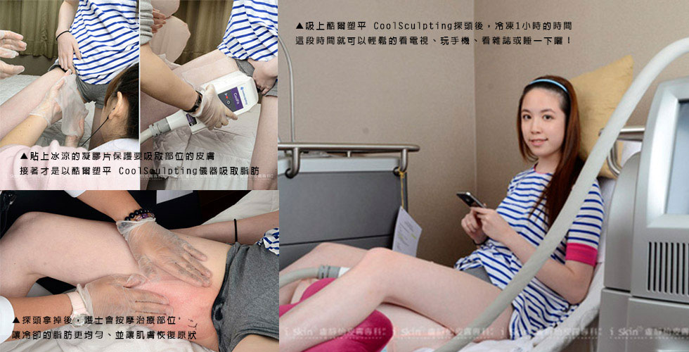 吸上酷爾塑平CoolSculpting探頭後，冷凍1小時的時間，這段時間就可以輕鬆的看電視、玩手機、看雜誌或睡一下囉！